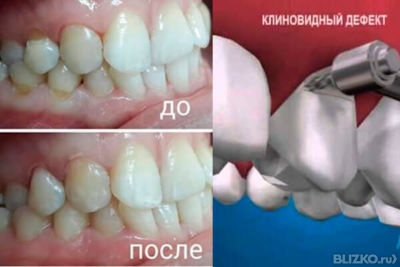 Лечение клиновидного дефекта