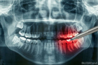 Рентгенография зуба. Справка с заключением стоматолога